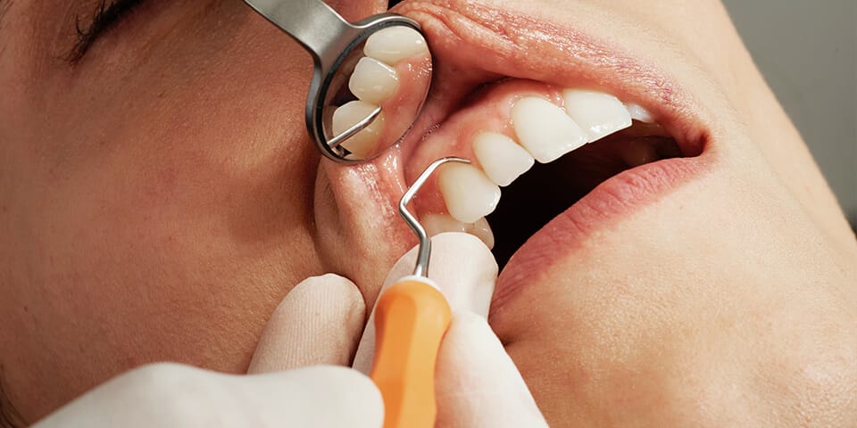 Cos’è la parodontite